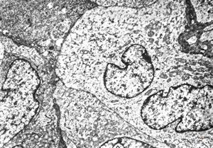 F,52y. | epitheloid sarcoma - knee